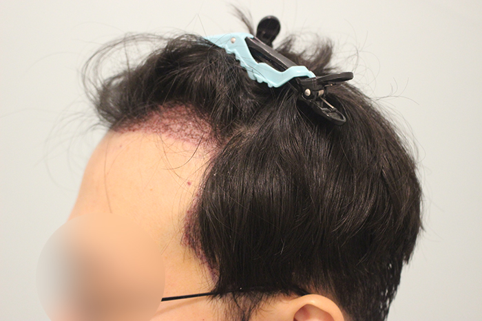 수술후 1일 (4).JPG