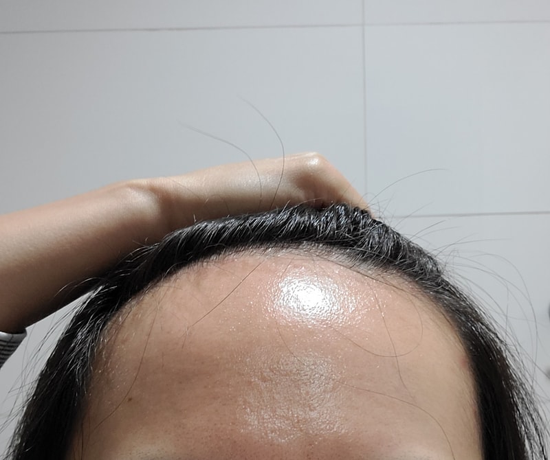 모디헤어플란트 모발이식 수술 후기>_<