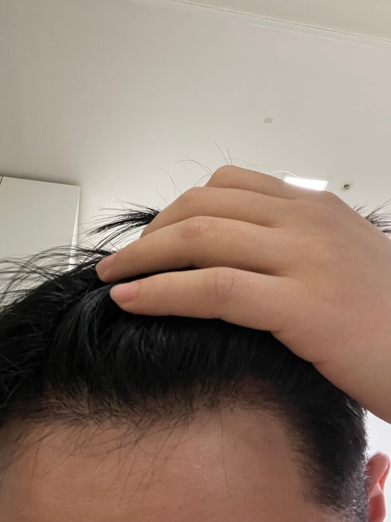 비절개 시술 2739모 약 4개월 경과