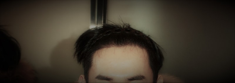 수술후_정면2.jpg