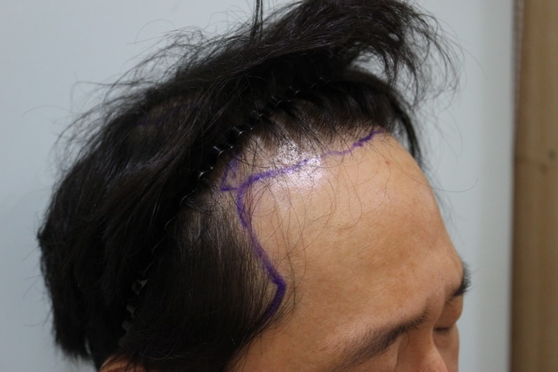 수술전디자인 (1).jpg