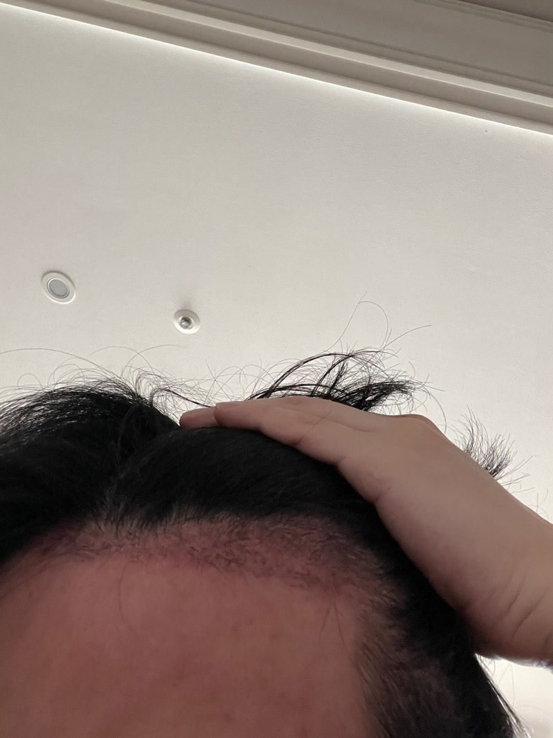 手術3ヶ月目の写真をアップします。