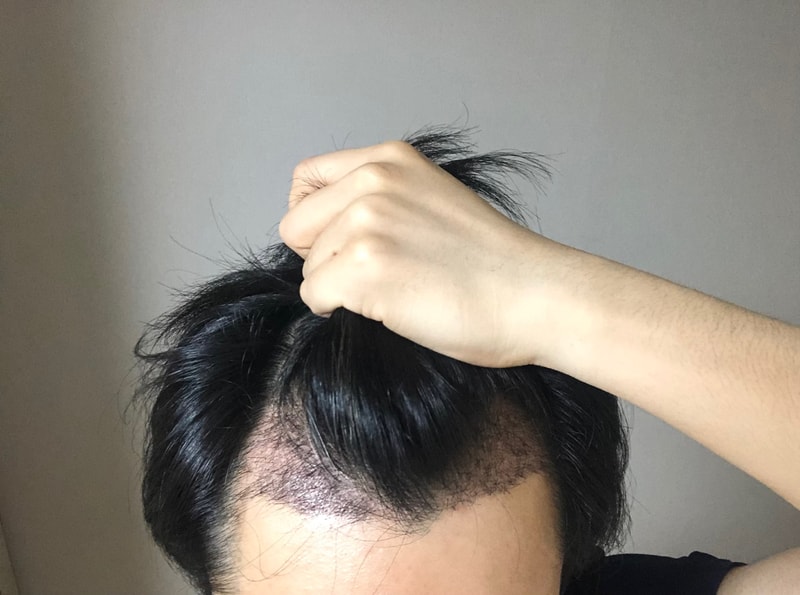 수술 한달차.jpg