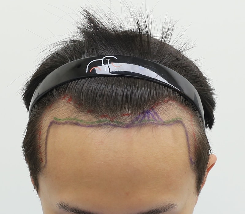 Review of Apgujeong Mammoth Hair Restoration Center's Wide Forehead Non-Cutting Hair Transplant
