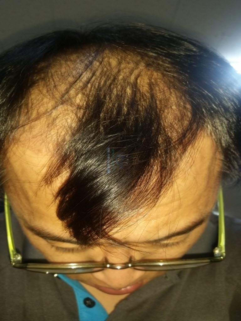 수술후2개월.jpg