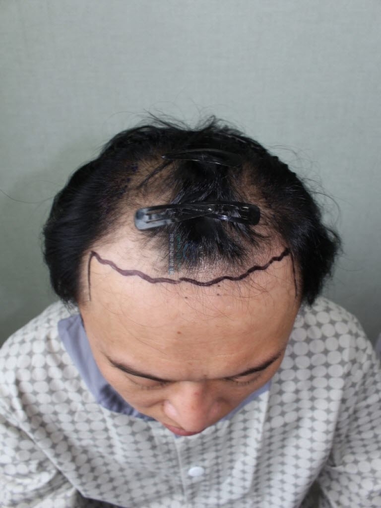 절개이식 4400모가량 ..이제 정점을 향해가는것 같습니다.