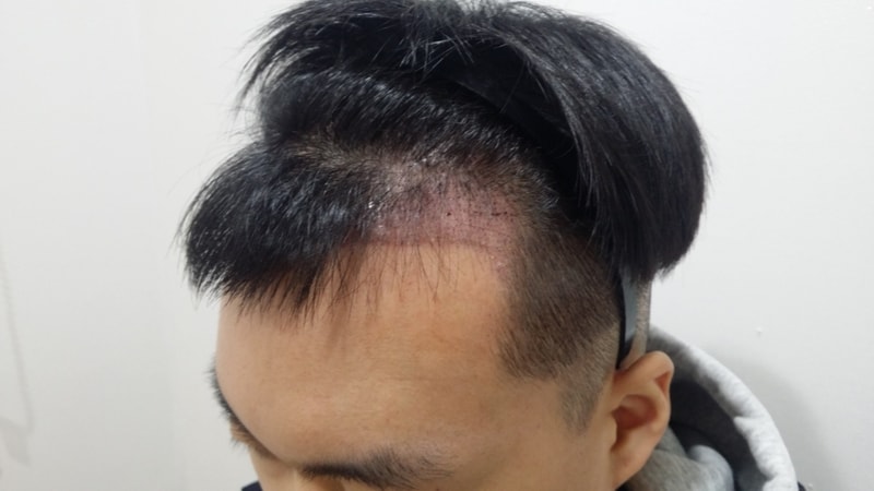 비절개 1일 차 후기