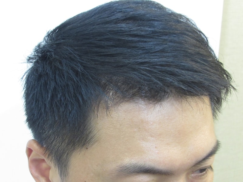 1년 3개월 경과 (오른쪽).png