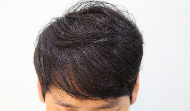 수술후 1년 (4).JPG