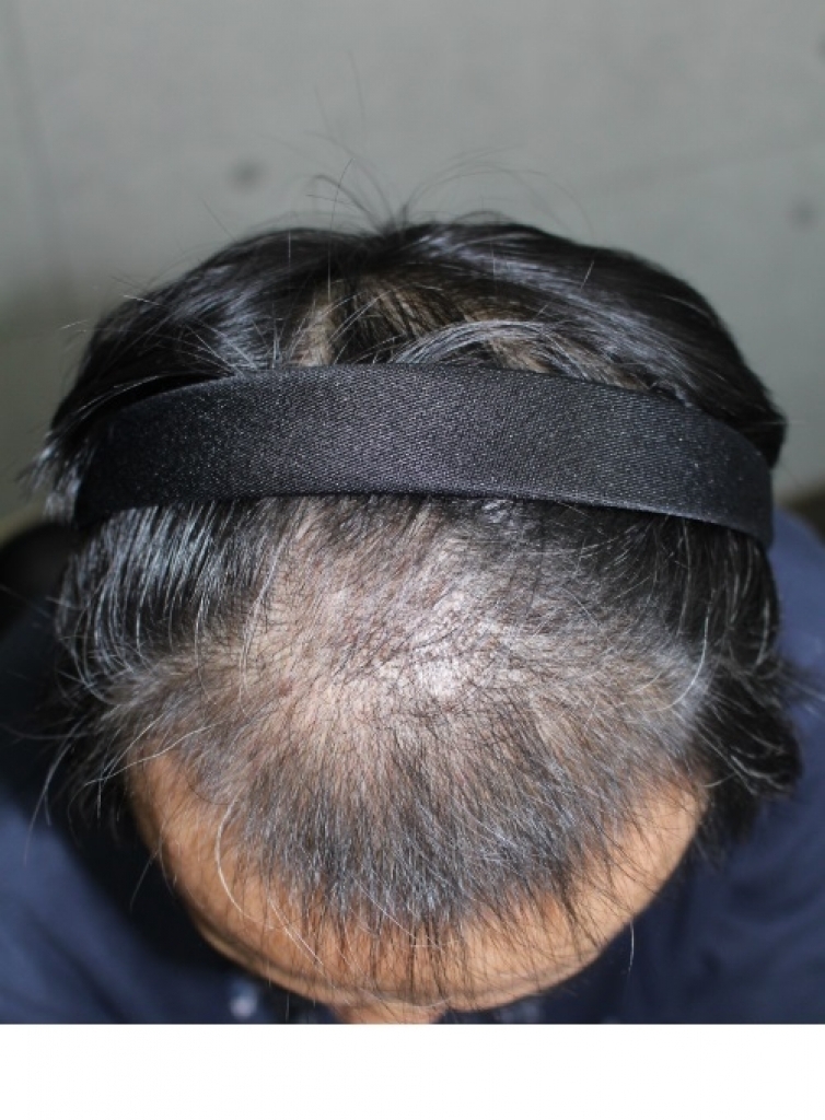 이식후1.jpg
