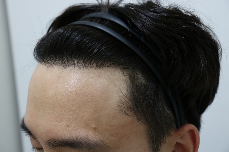 [크기변환]1년경과 왼쪽.jpg