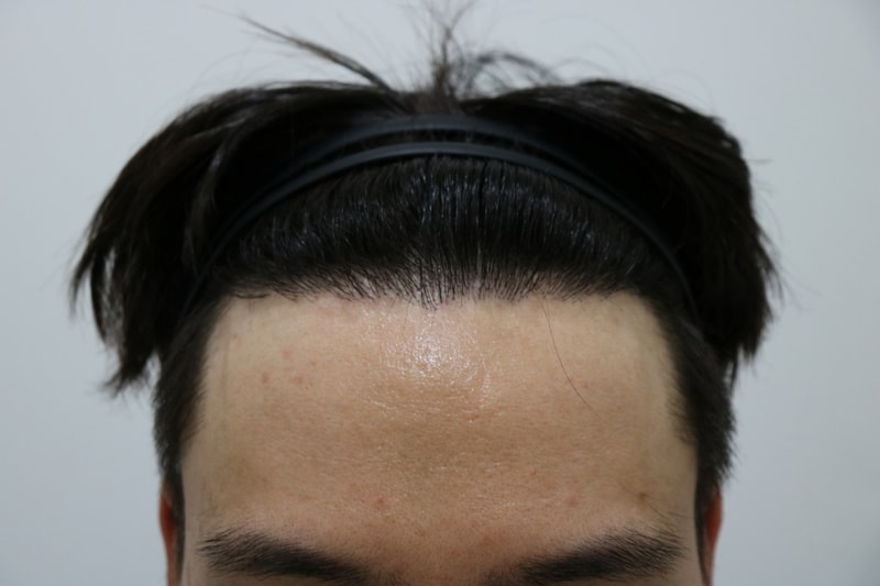 [크기변환]1년경과 정면.jpg