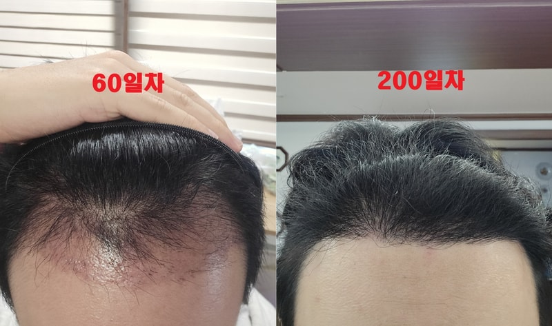 노블라인 이식 200일차 입니다~(암흑기 지났어요)