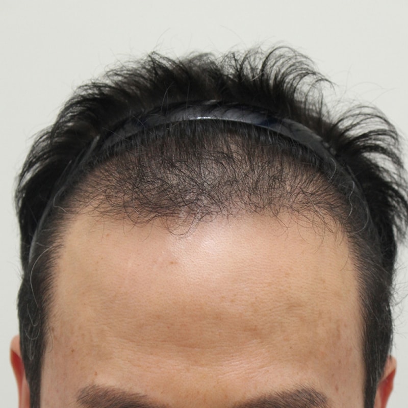 8.수술6개월째.jpg