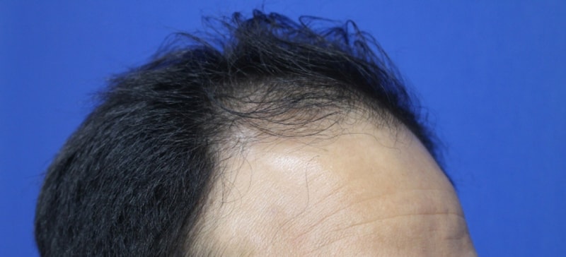 I lost a lot of hair in the 3rd month of surgery