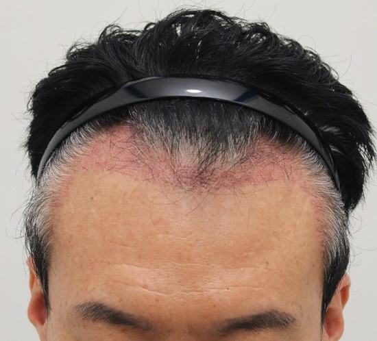 4. 수술3개월.jpg