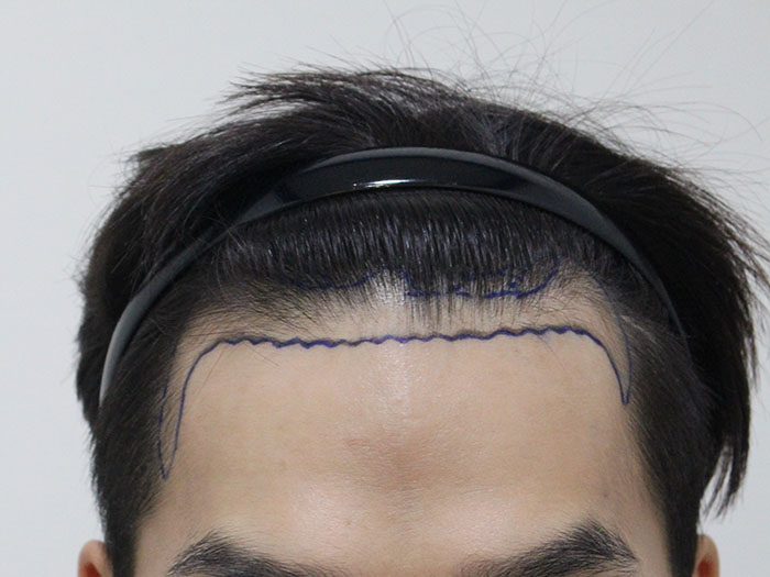 작년 8월에 수술받고 1년이됩니다