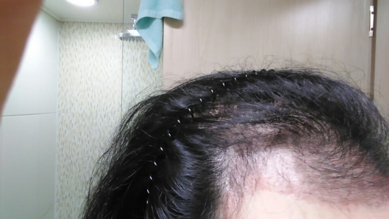 모앤블레스 비절개법 수술한지 두달됐습니다ㅎ 총 3650모
