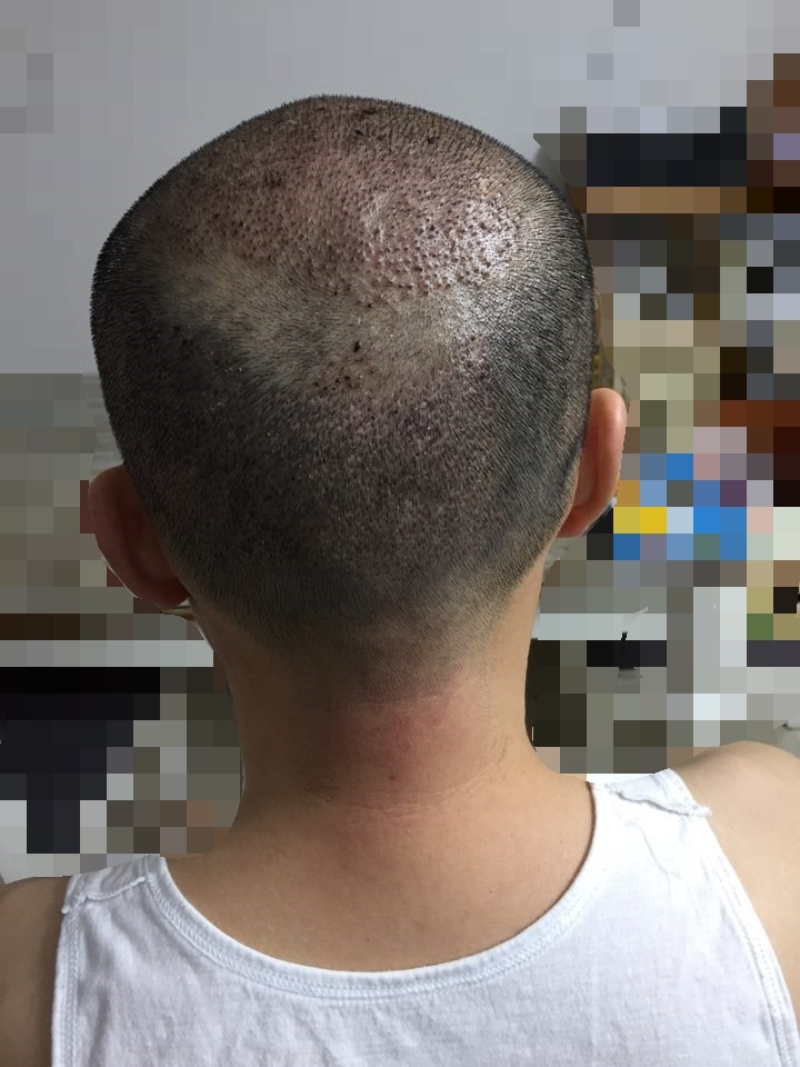 4. 수술7일째.jpg