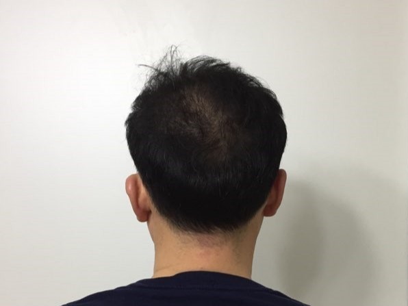 7. 수술9개월째.jpg