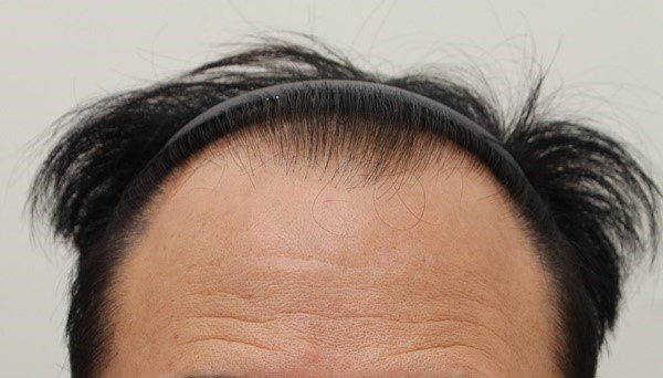 수술전.jpg