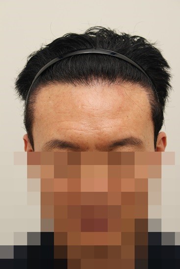 10. 수술9개월.jpg