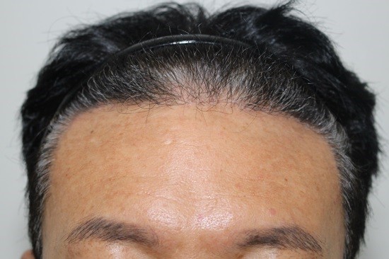 7. 수술6개월.jpg