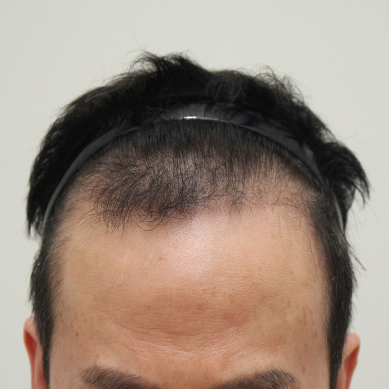7.수술4개월째.jpg