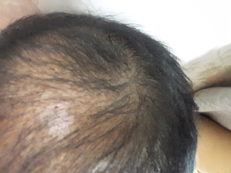 모앤블레스 4670모 회복 2개월차입니다
