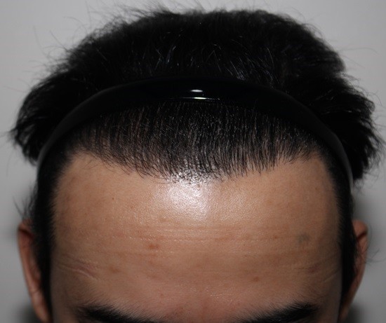 12수술1년째.jpg