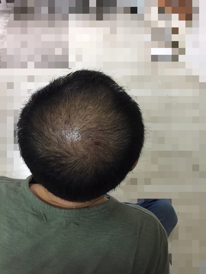 6. 수술2개월째.jpg