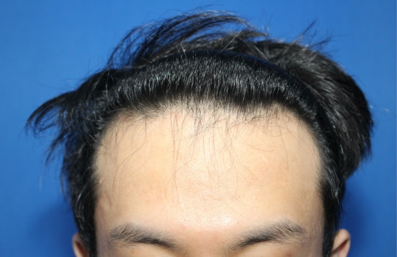 비절개로 2750모 수술받았는데 홀가분합니다