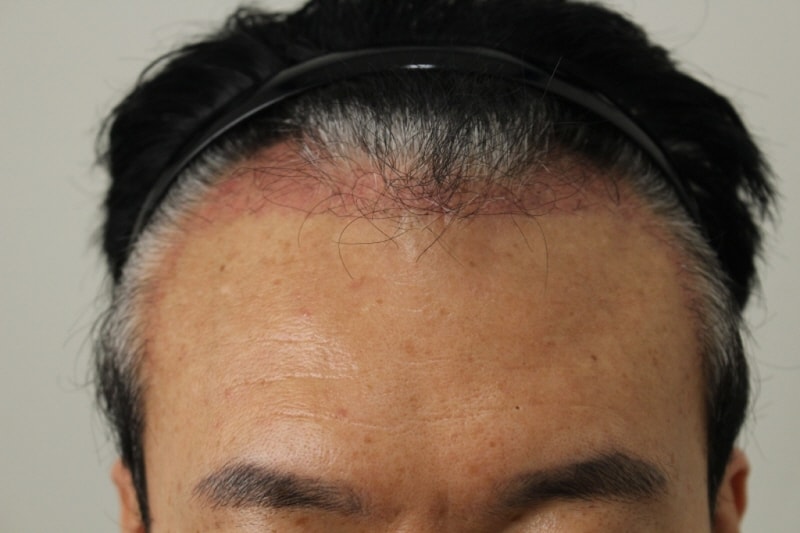 It's been a month since I had 2860 hair surgery It's still very obvious