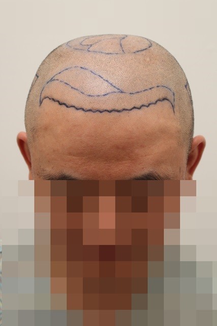 수술한지 5개월 됐어요