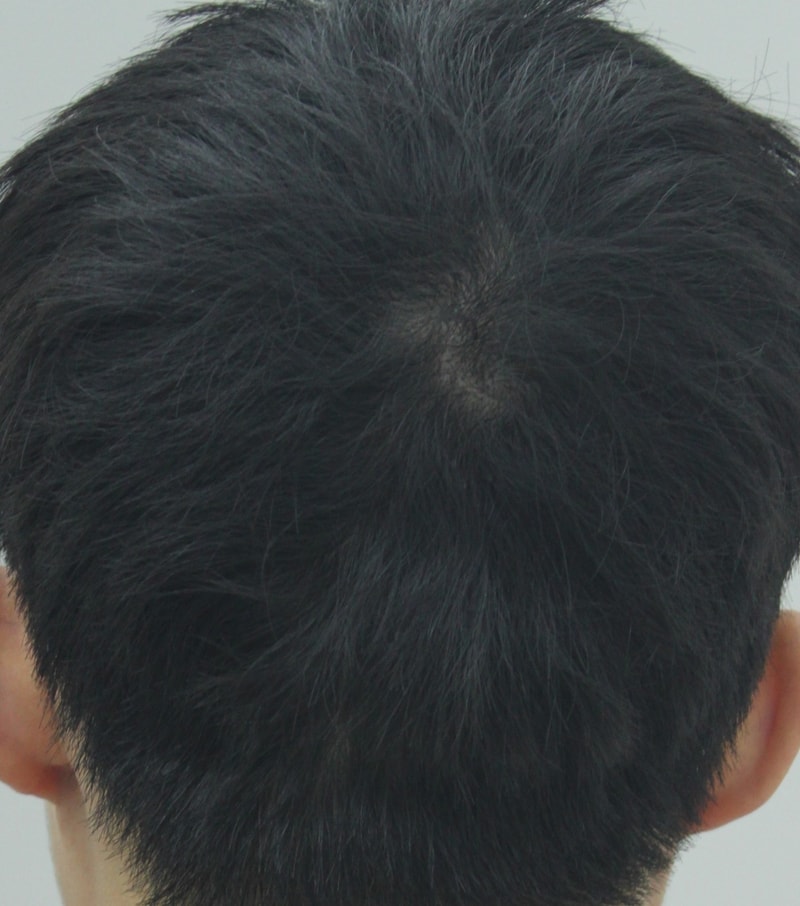 수술전 뒷통수.jpg
