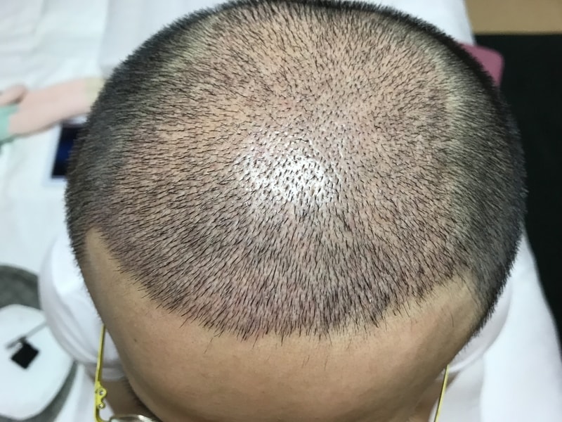 딱지 제거 후 현 상태 회원님 생각에 어떤가요??