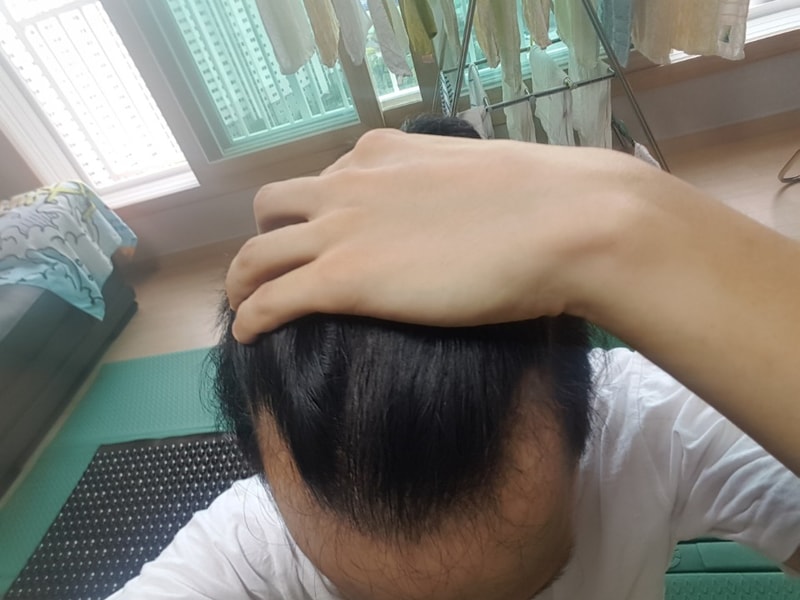 4000모 비절개 수술4일차