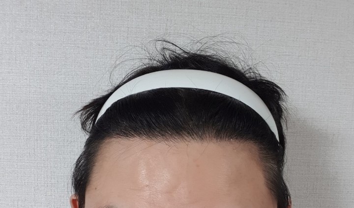 수술8개월후기입니다