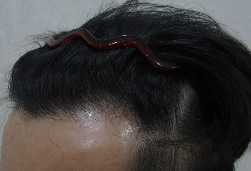 수술전 L(접).JPG
