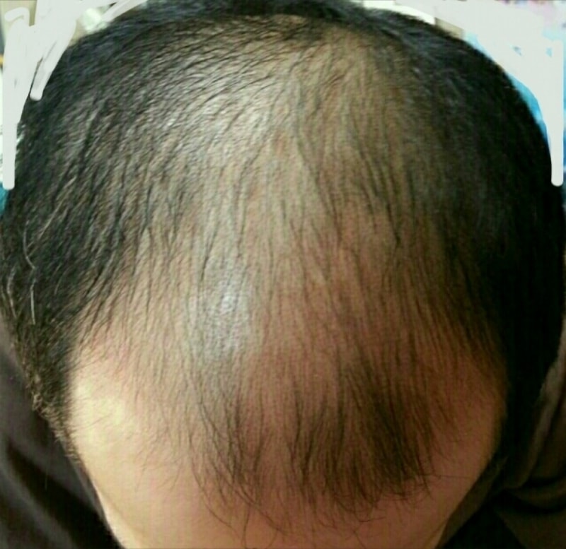1차 4000모 실패후, 2차 2500모낭 이식 5개월차 모자를 벗게 되네요.