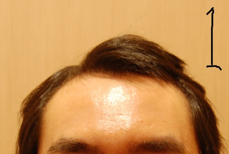 이식전 1.JPG