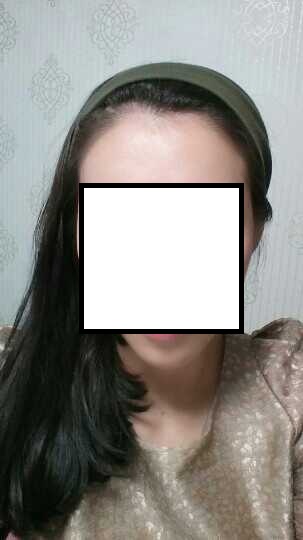 다나성형외과 헤어라인 절개 1800모 후기!