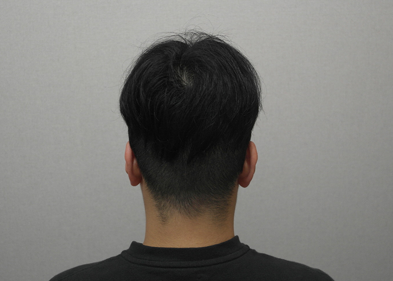 5. 2주 샴푸 후 뒷머리입니다 투블럭 삭발했는데 제법 많이 길어서 다음주쯤 머리 다듬을 예정입니다.JPG