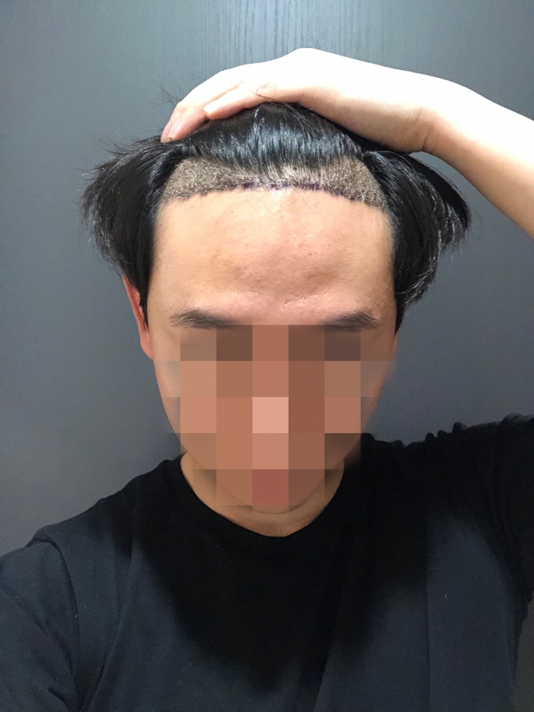 10.이대영_수술 일주일.jpg
