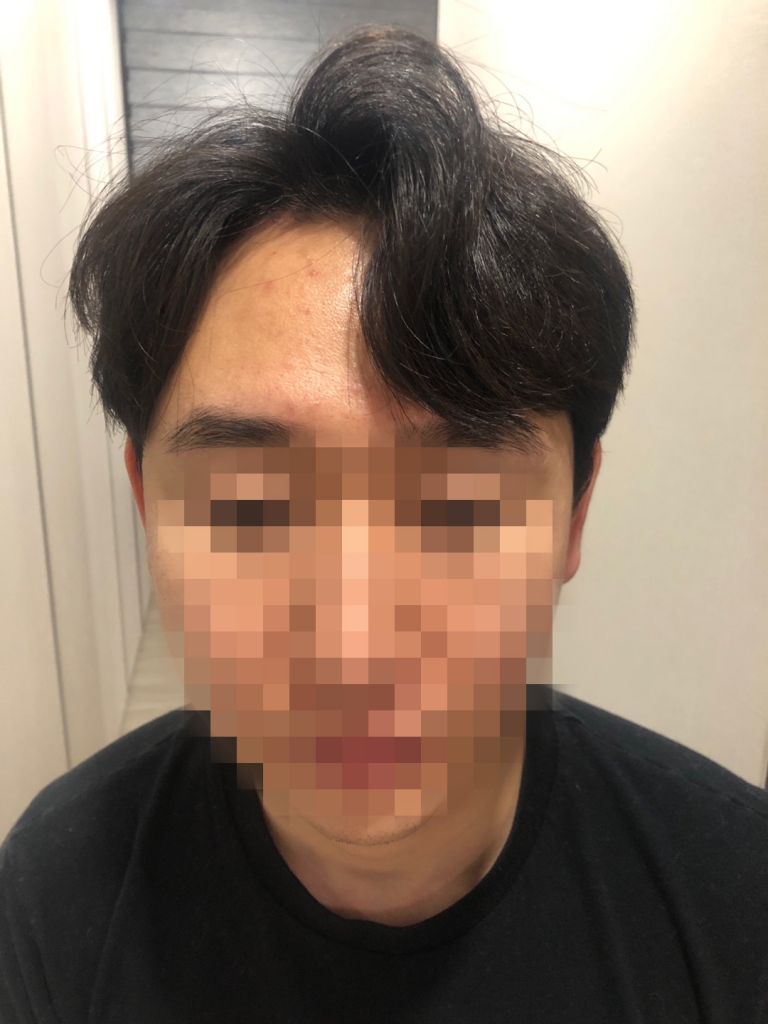 01.이대영_수술 1달.jpg