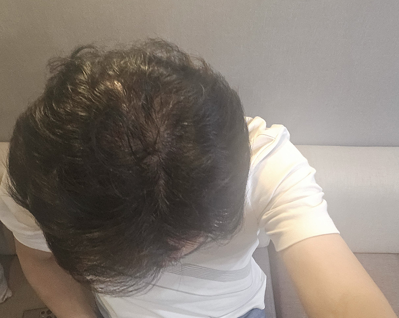 6. 정수리 1년1개월 가르마부위는 안심은거예요.jpg