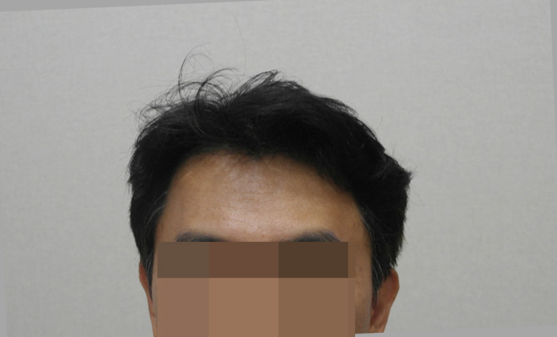 9. 수술후 헤어스타일.JPG