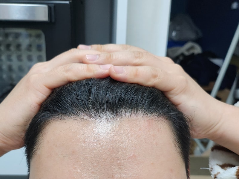 다나 무삭발 모발이식 8개월 진짜 자연스럽습니다