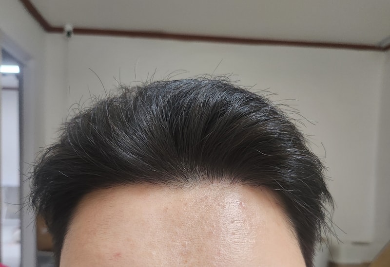 다나 무삭발 비절개 14개월 후기