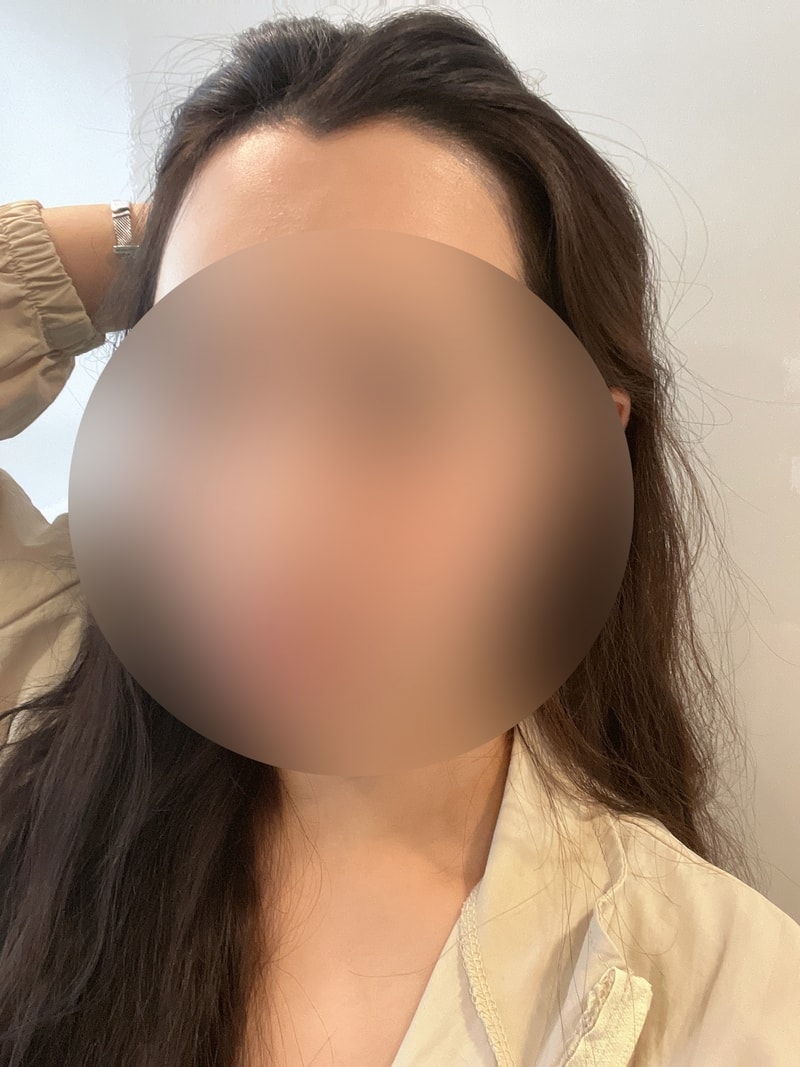 After the hairline tattoo, it's been 6 months since the hairline transplant.